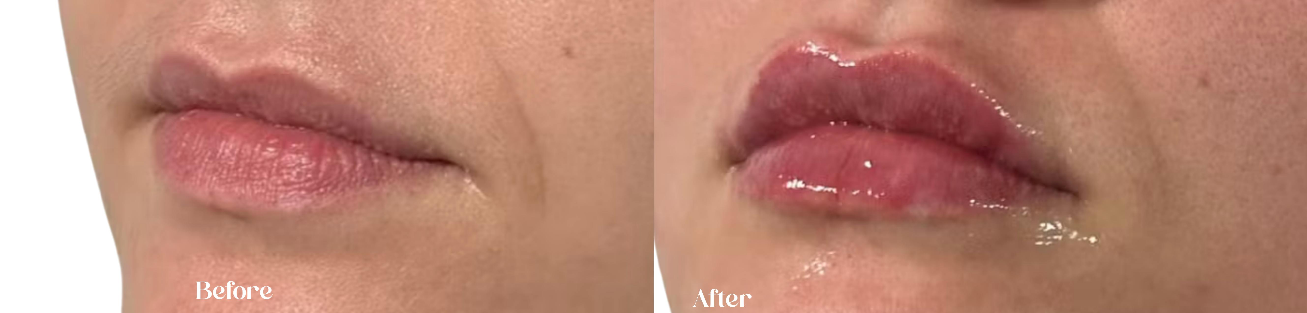 House of Glo before and after lip filler