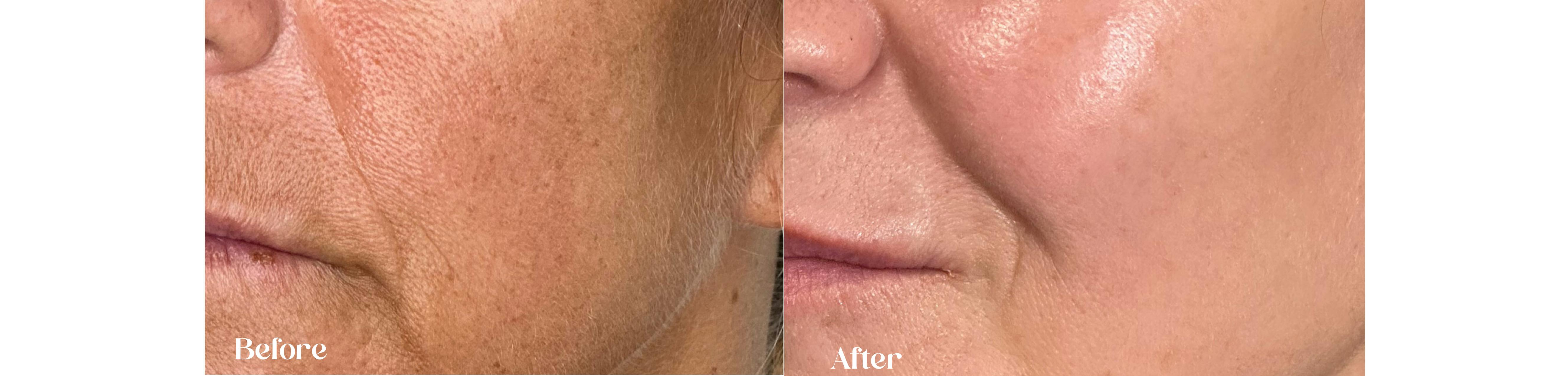 House of Glo filler for lines and wrinkles before and after