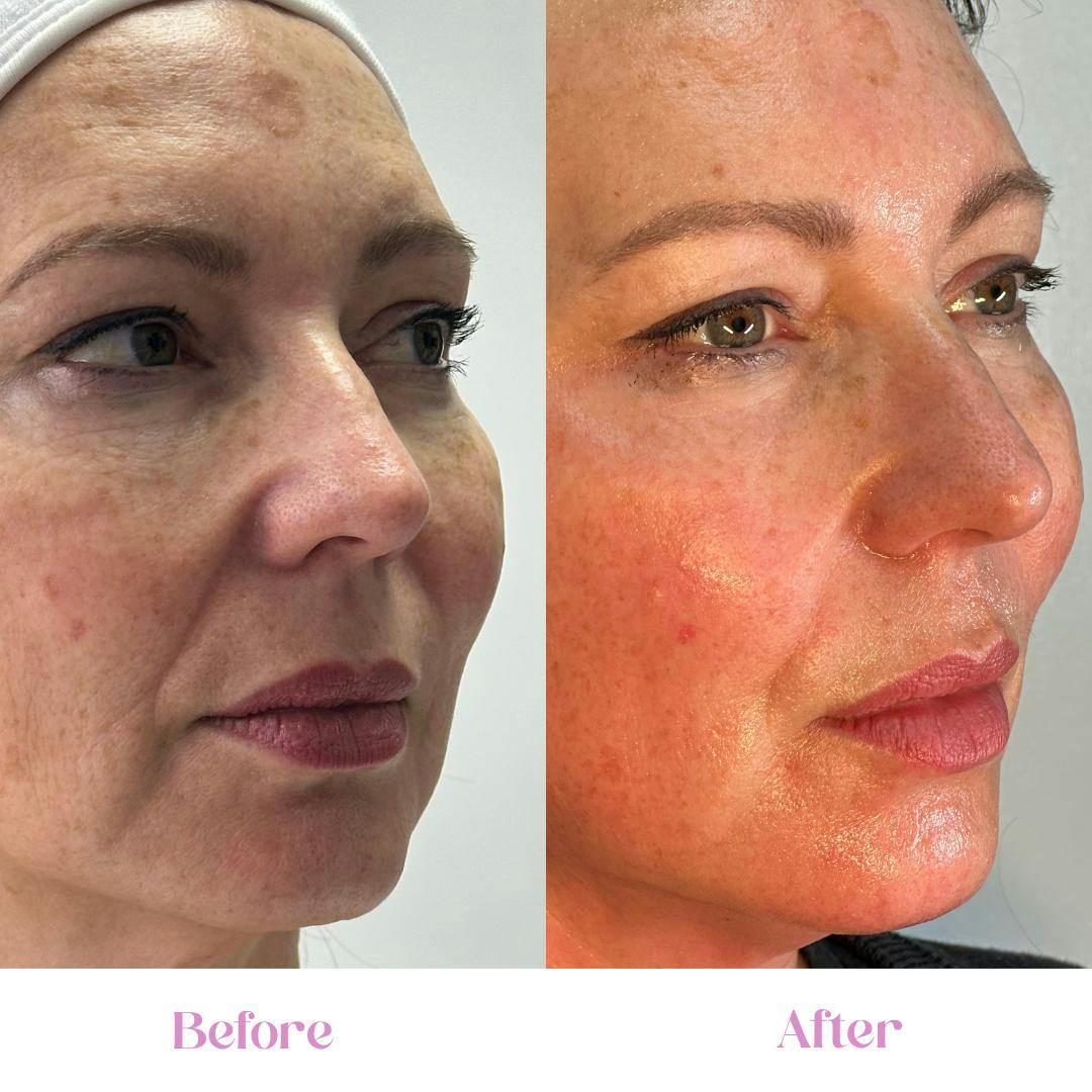 House of Glo Treatment before and after