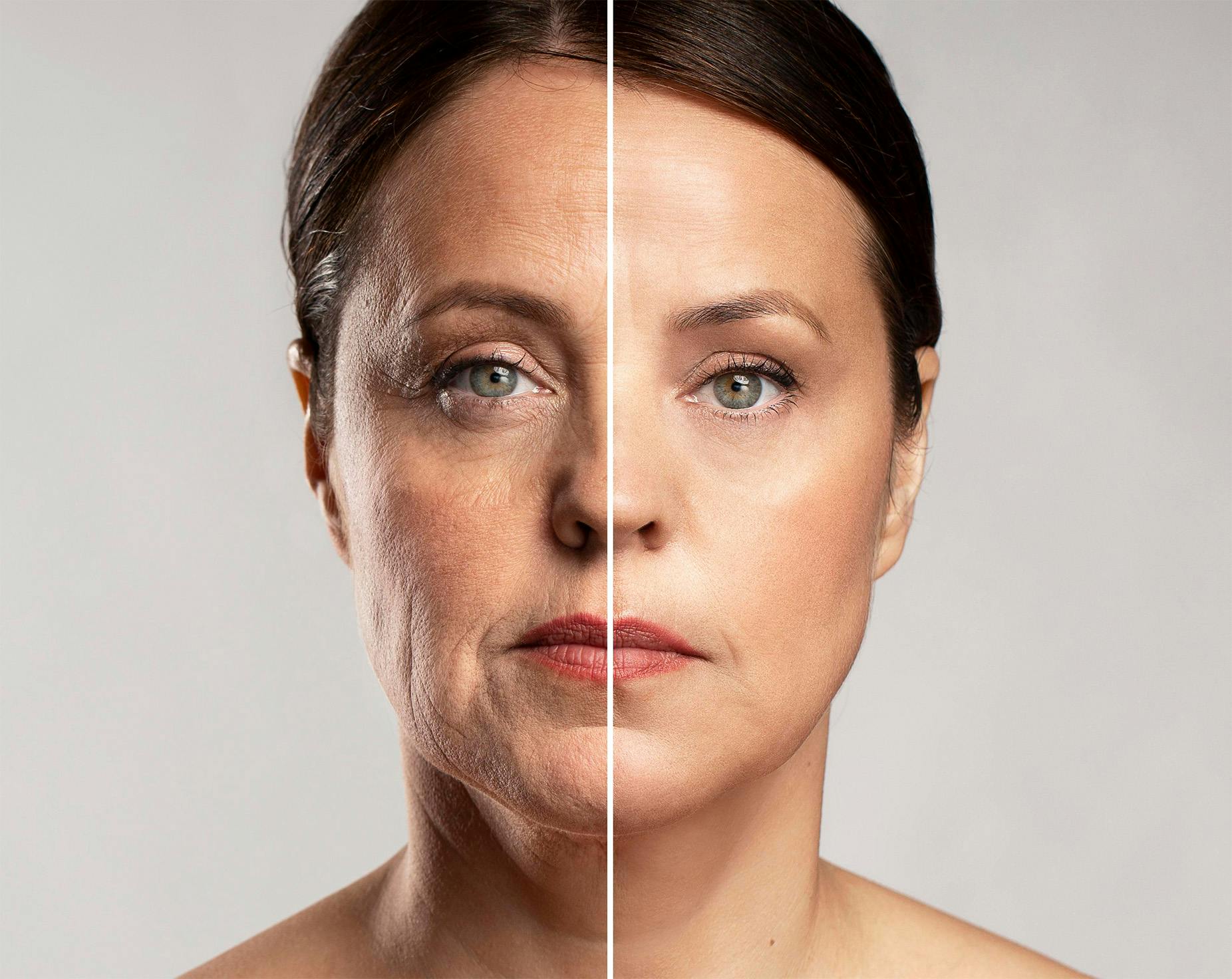 a womans face comparison after full face anti wrinkle treatment