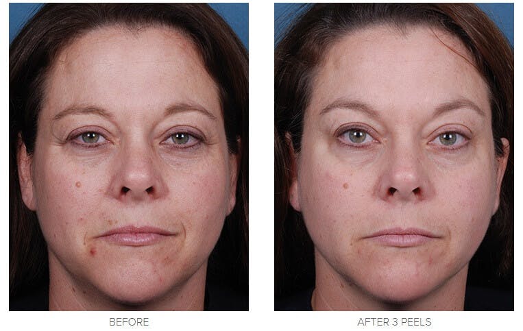 Obagi Blue Peel Radiance before and after results