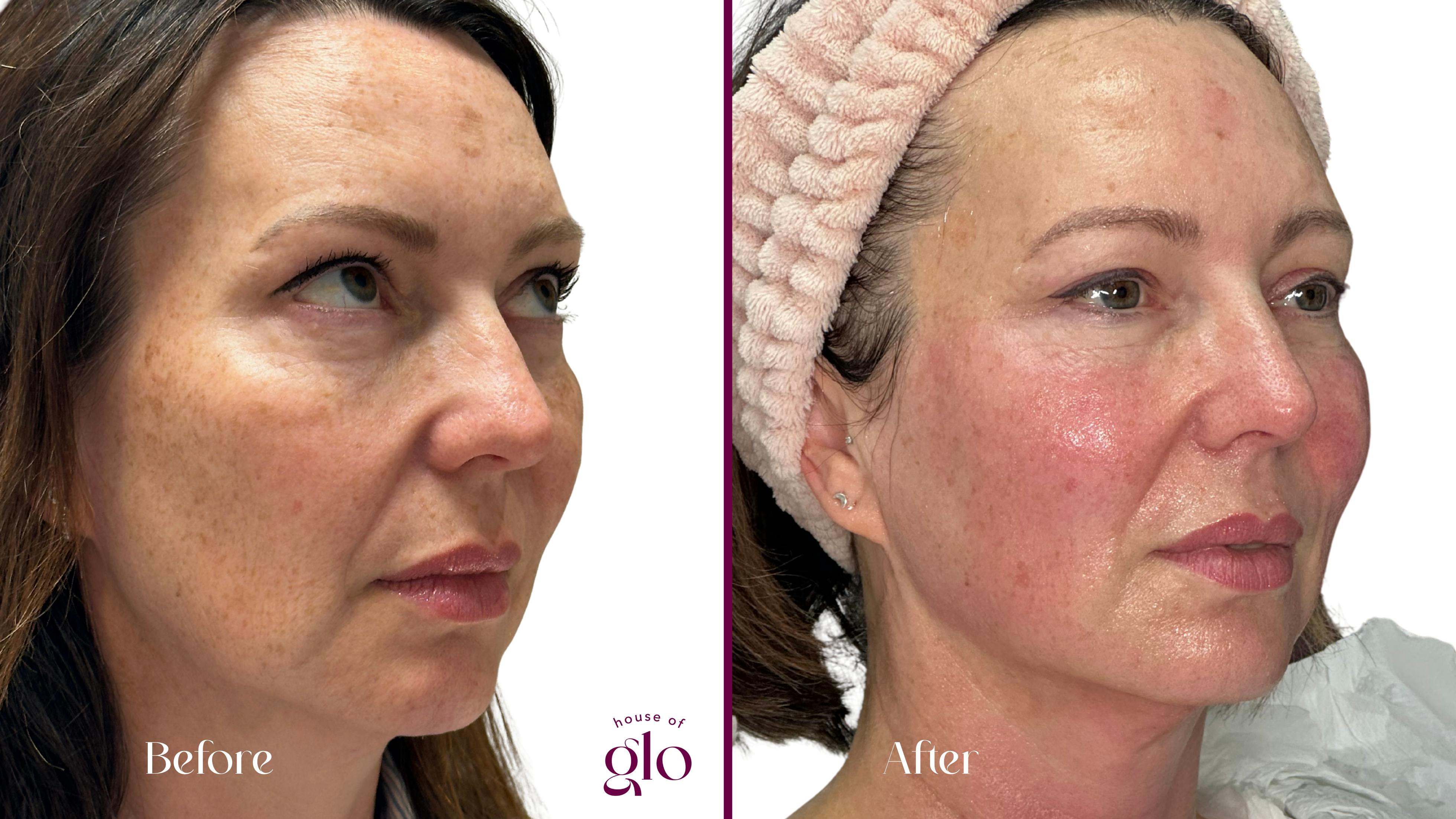 Nboost skin booster Before and After results at House of Glo