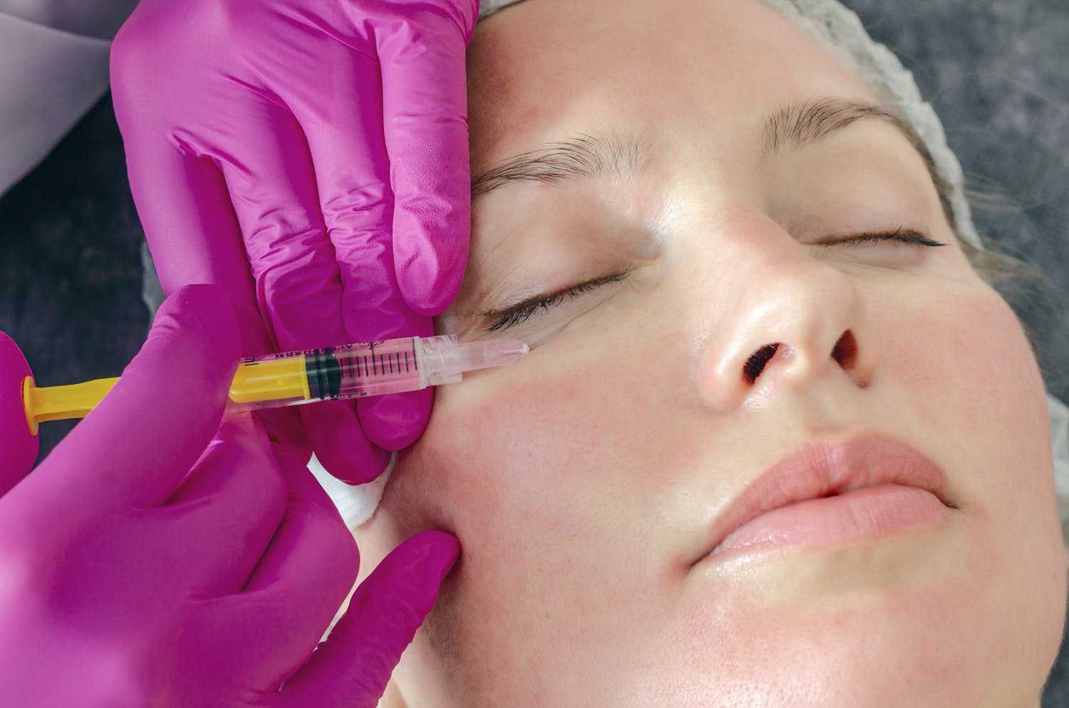 Vampire facial treatment being performed