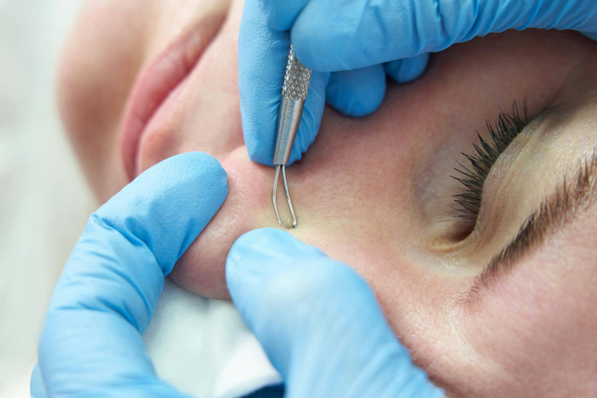 Milia removal treatment being performed