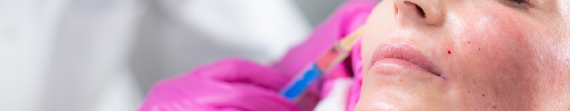 woman having cheek filler dissolving treatment