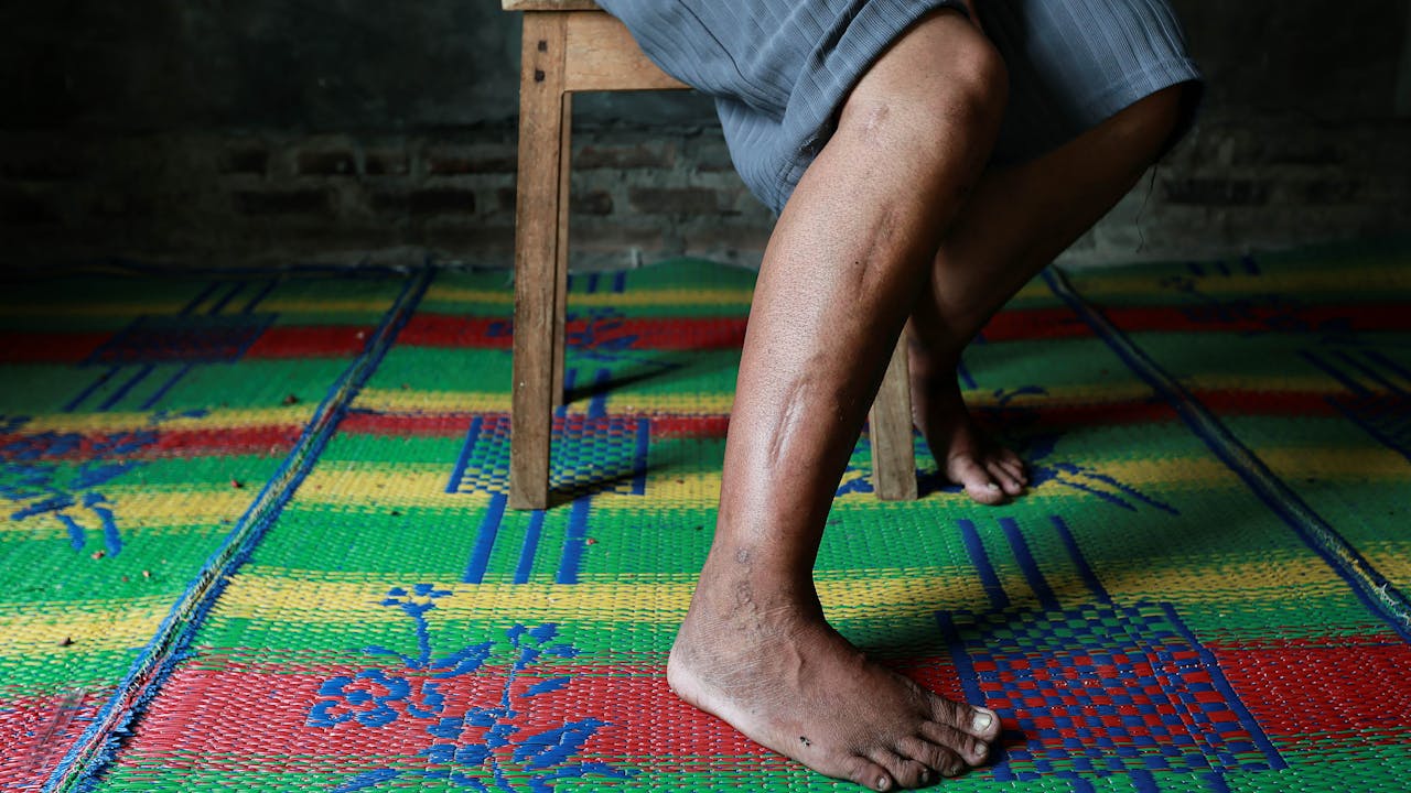 Win Faidah shows several deep scars on her legs from the abuse of her former employers. She sits on a wooden stool.