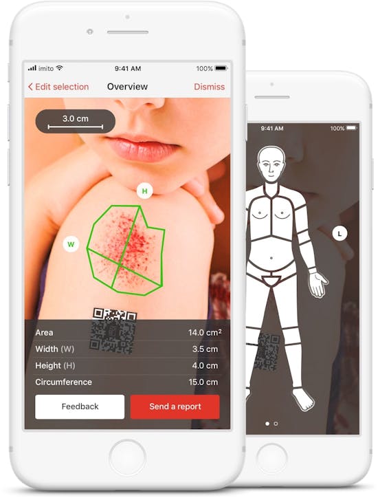 Kostenlose App zur Wundvermessung - imitoMeasure