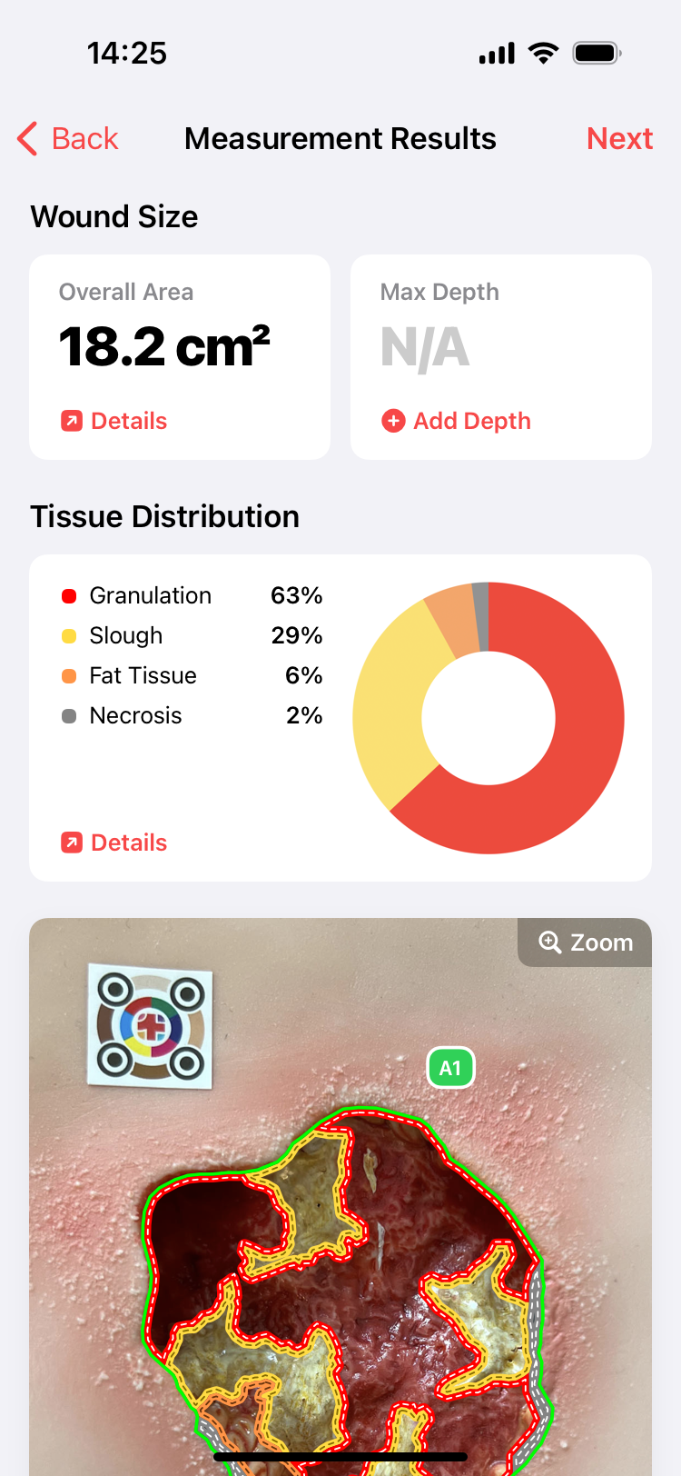 Application de mesure des plaies - imitoWound