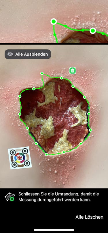 Wundlineal ciao ciao - Wundvermesssung ist heutzutage digital