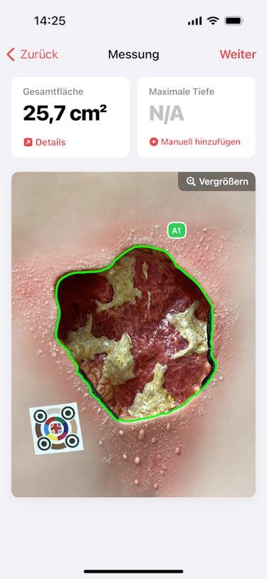 Wundfläche berechnet in Sekunden