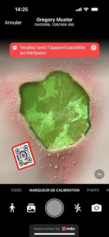 Règle à plaies ciao ciao - la mesure des plaies est aujourd'hui numérique