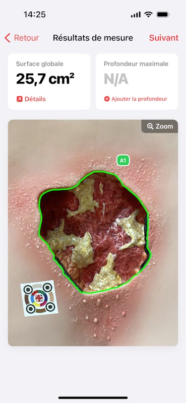 Règle à plaies ciao ciao - la mesure des plaies est aujourd'hui numérique