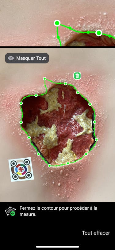 Règle à plaies ciao ciao - la mesure des plaies est aujourd'hui numérique