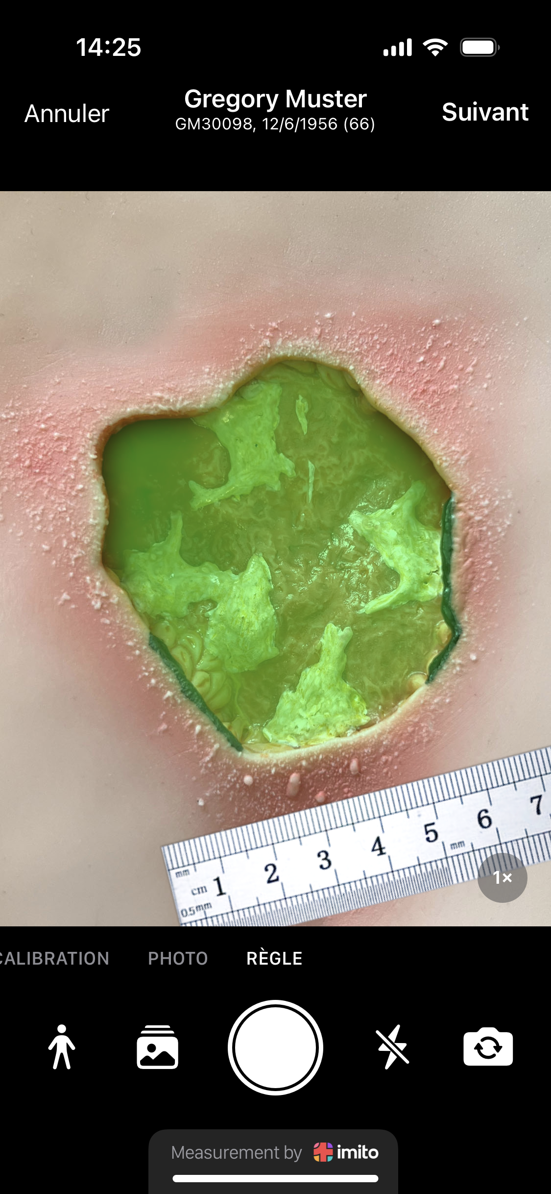 Règle à plaies ciao ciao - la mesure des plaies est aujourd'hui numérique