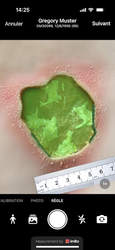 Règle à plaies ciao ciao - la mesure des plaies est aujourd'hui numérique