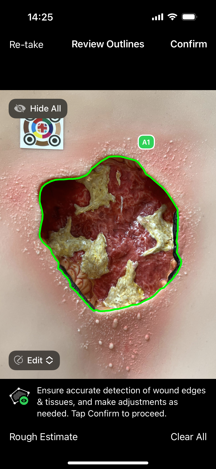 Wound Assessment Tool imitoWound - Wound Scanner Online