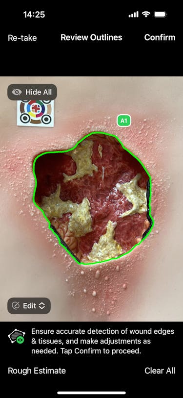 Wound Assessment Tool imitoWound - Wound Scanner Online