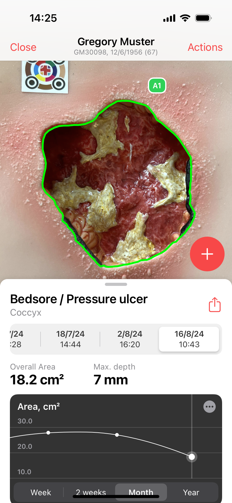 Application de mesure des plaies - imitoWound