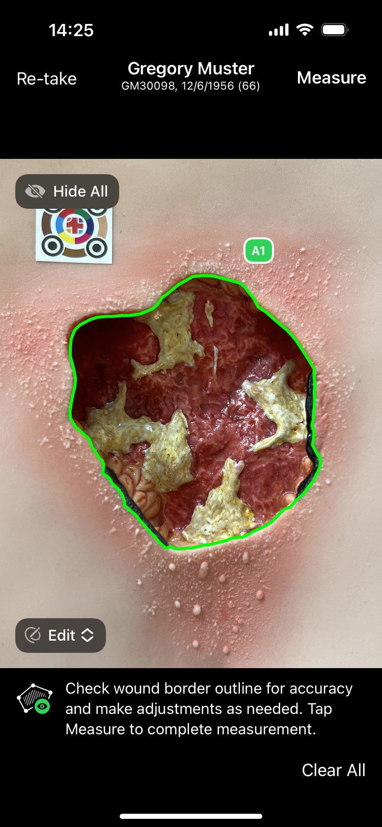 Wundvermessung und Wunddokumentation App imitoWound