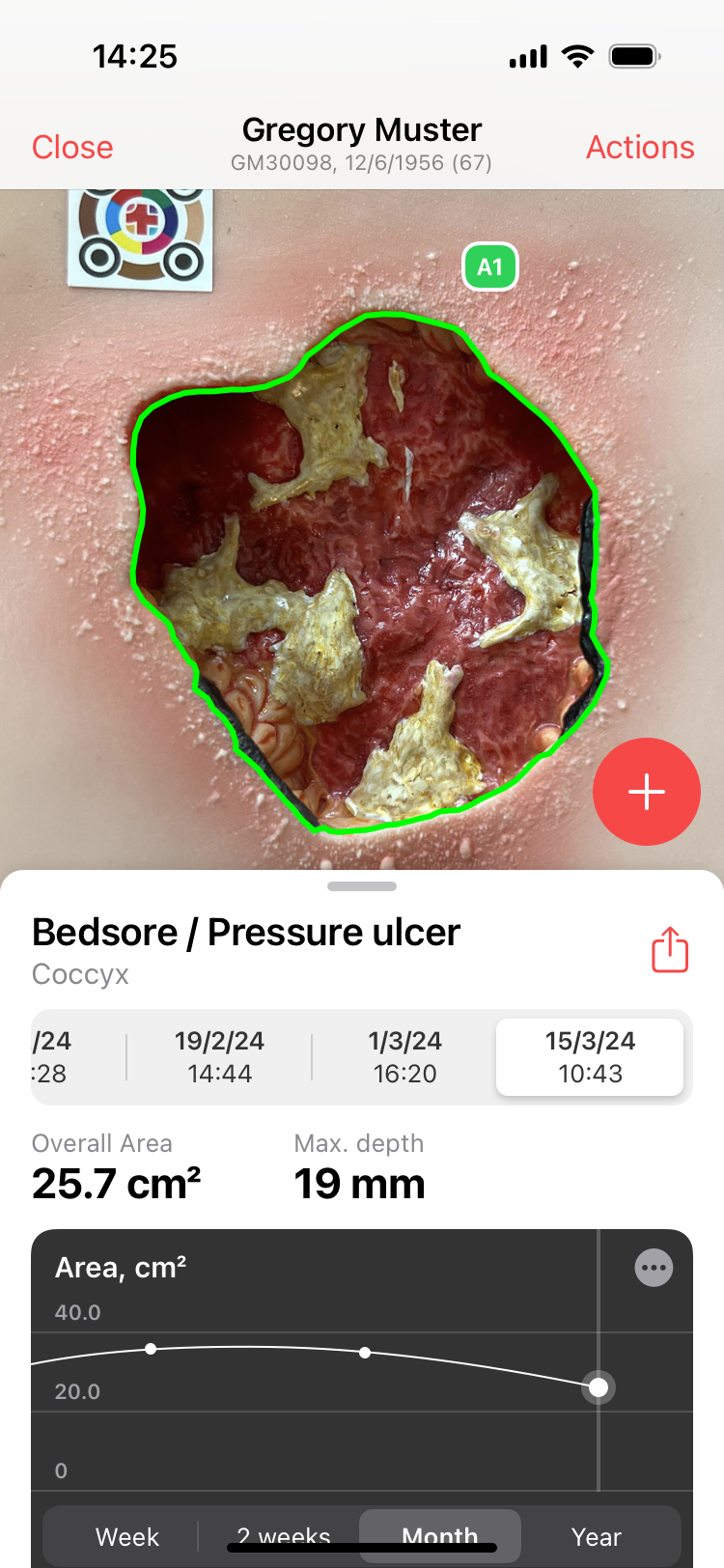 Wound measurement app - imitoWound