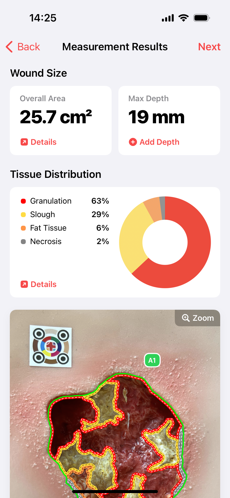 Wound measurement app - imitoWound