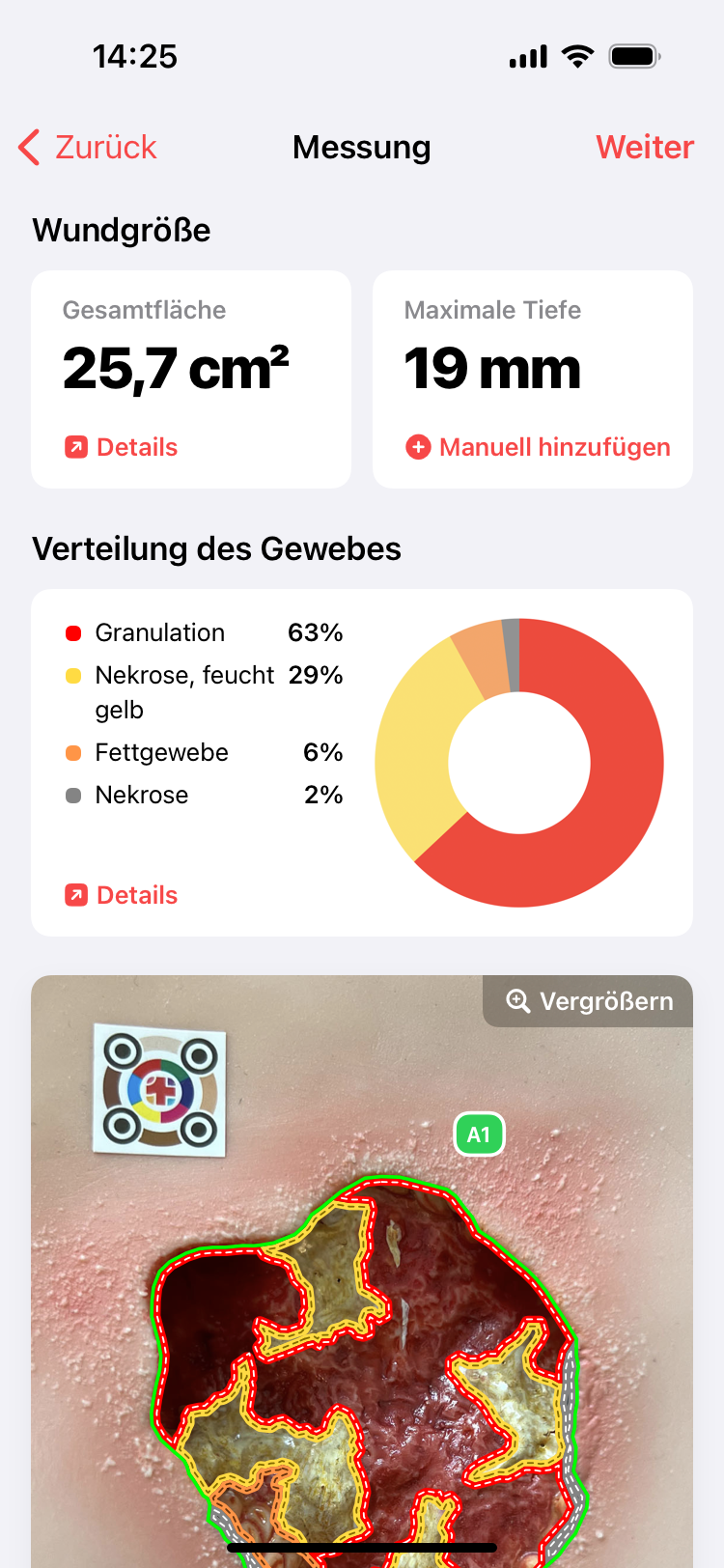 Wundvermessung und Wunddokumentation App imitoWound