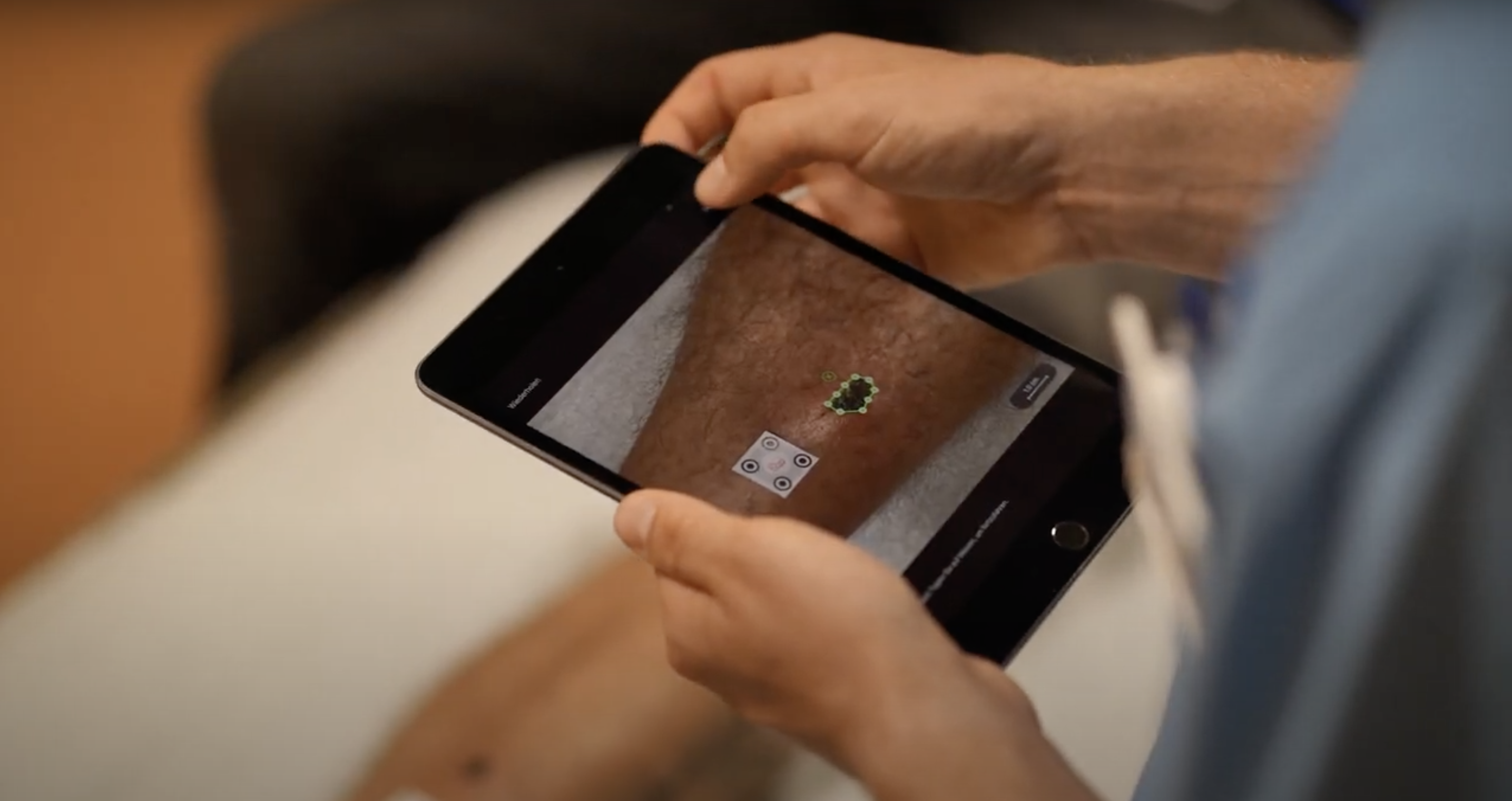 Wound measurement tool imitoWound