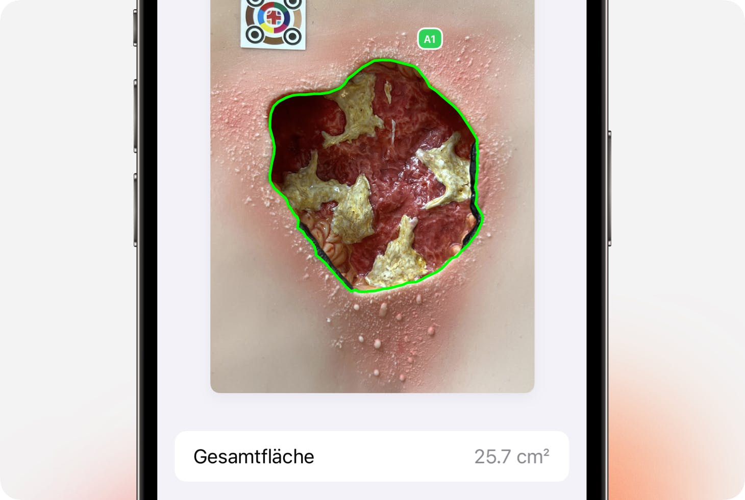 Wundvermessung in Sekunden mit imito's Wunddoku App