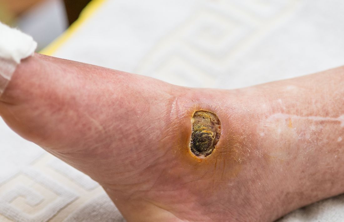 Comparer l'efficacité du PRP topique et injecté par la mesure de la taille des plaies