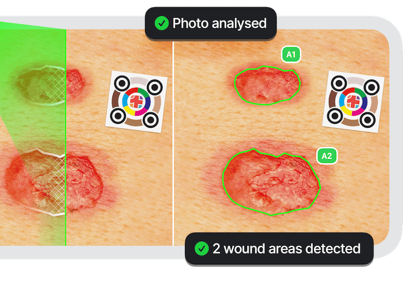 🦹 The first superpower for your wound analysis 🦸