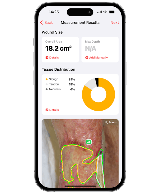 imitoWound - Wound Measurement and Tissue Distribution Details