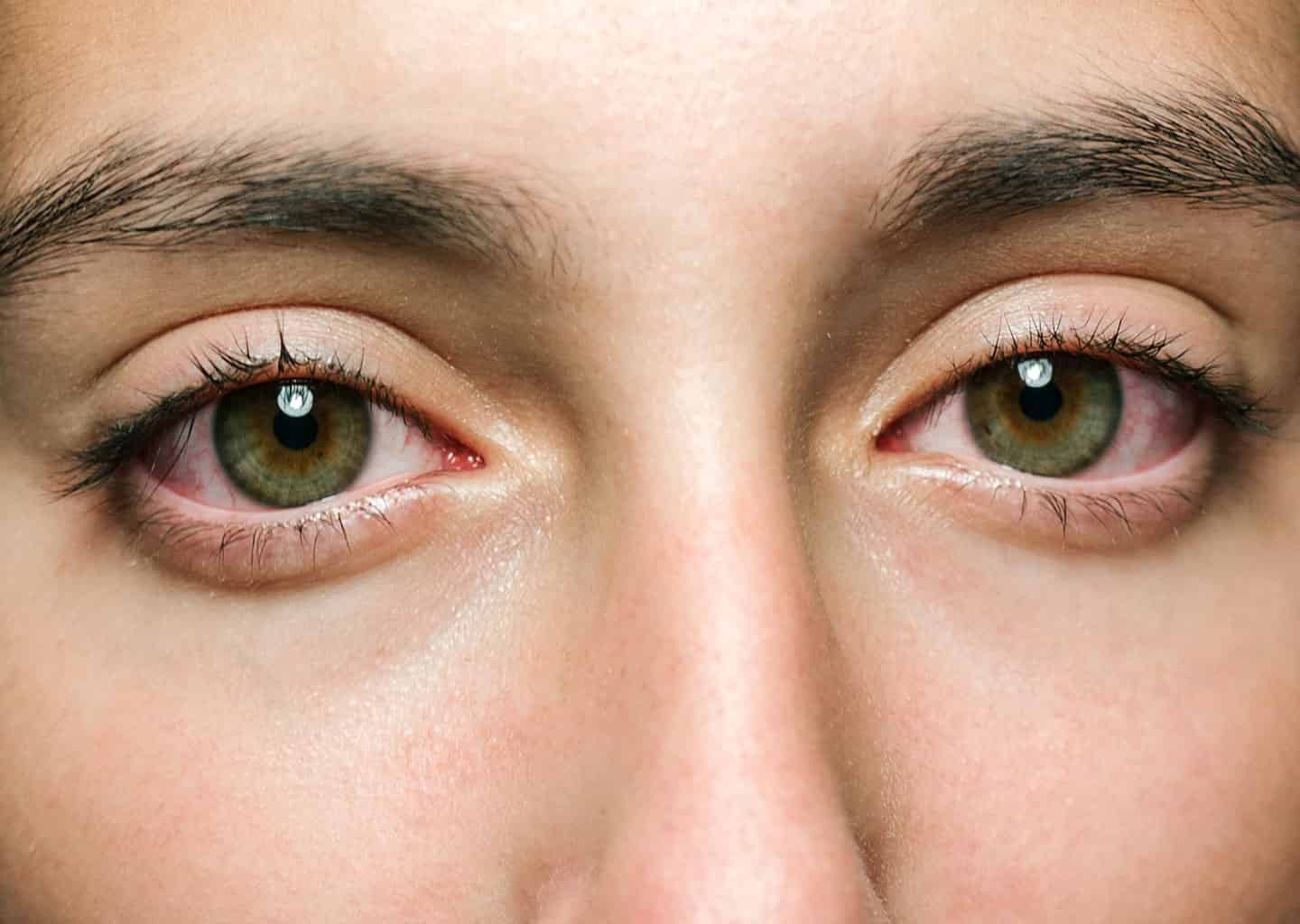 Yakın plan çekimde ela renkli gözleri olan kadının gözleri kanlanmış olarak duruyor.