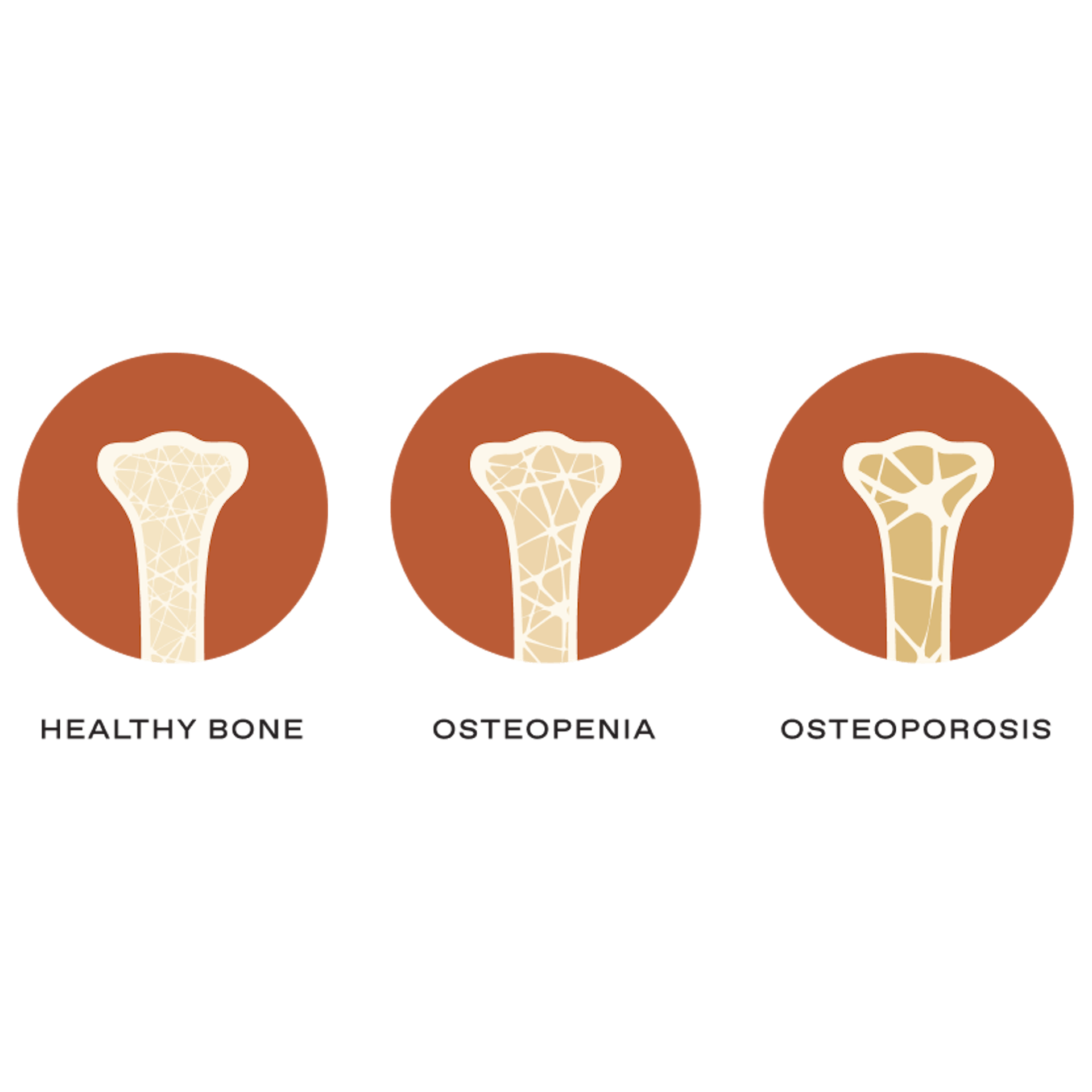 graphic of healthy bone, osteopenia, and osteoporosis