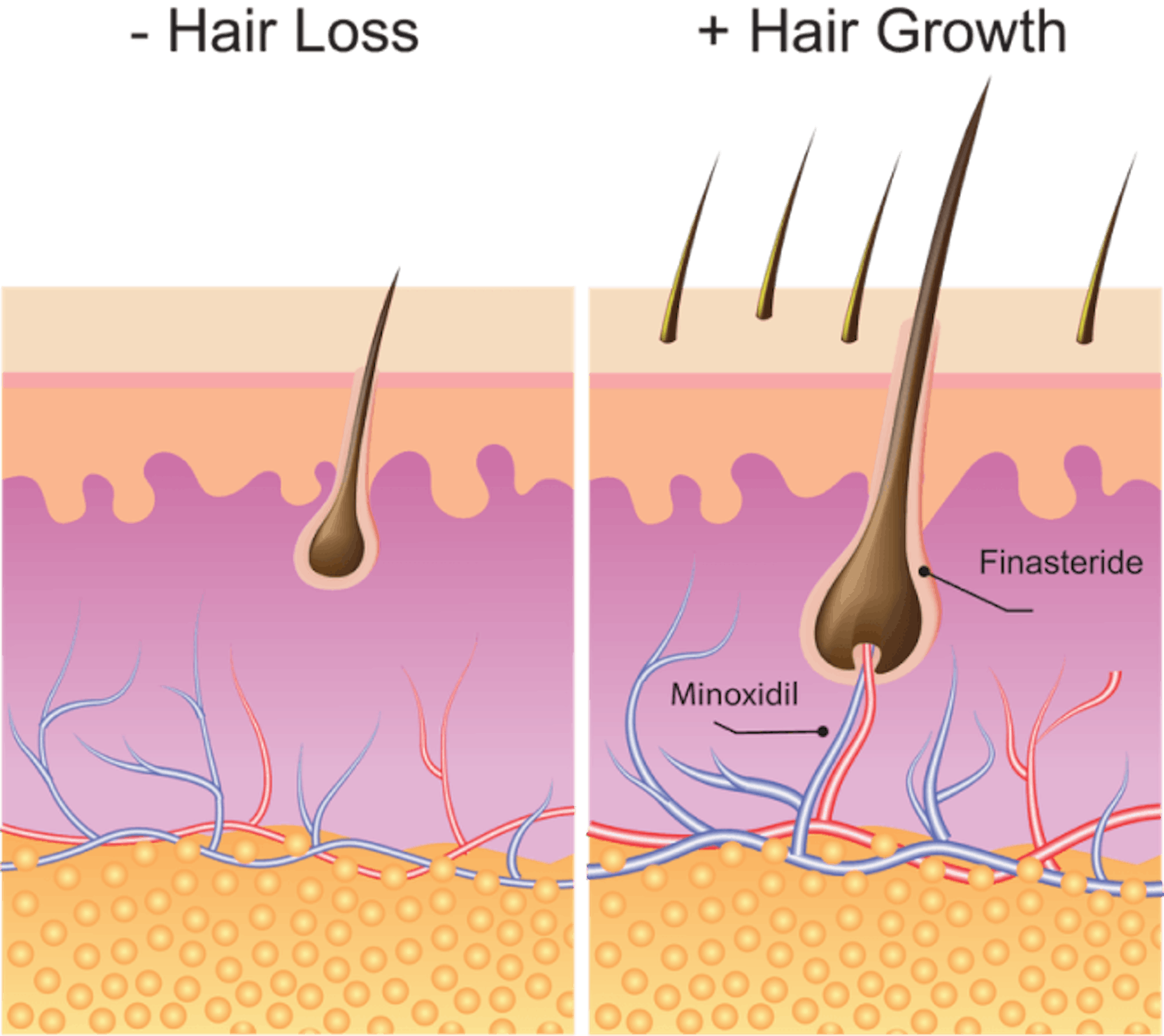 hair regrowth