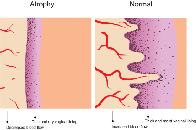 Illustrations of before and after estrogen levels decline, showing decreased blood flow and thinner, dryer vaginal lining