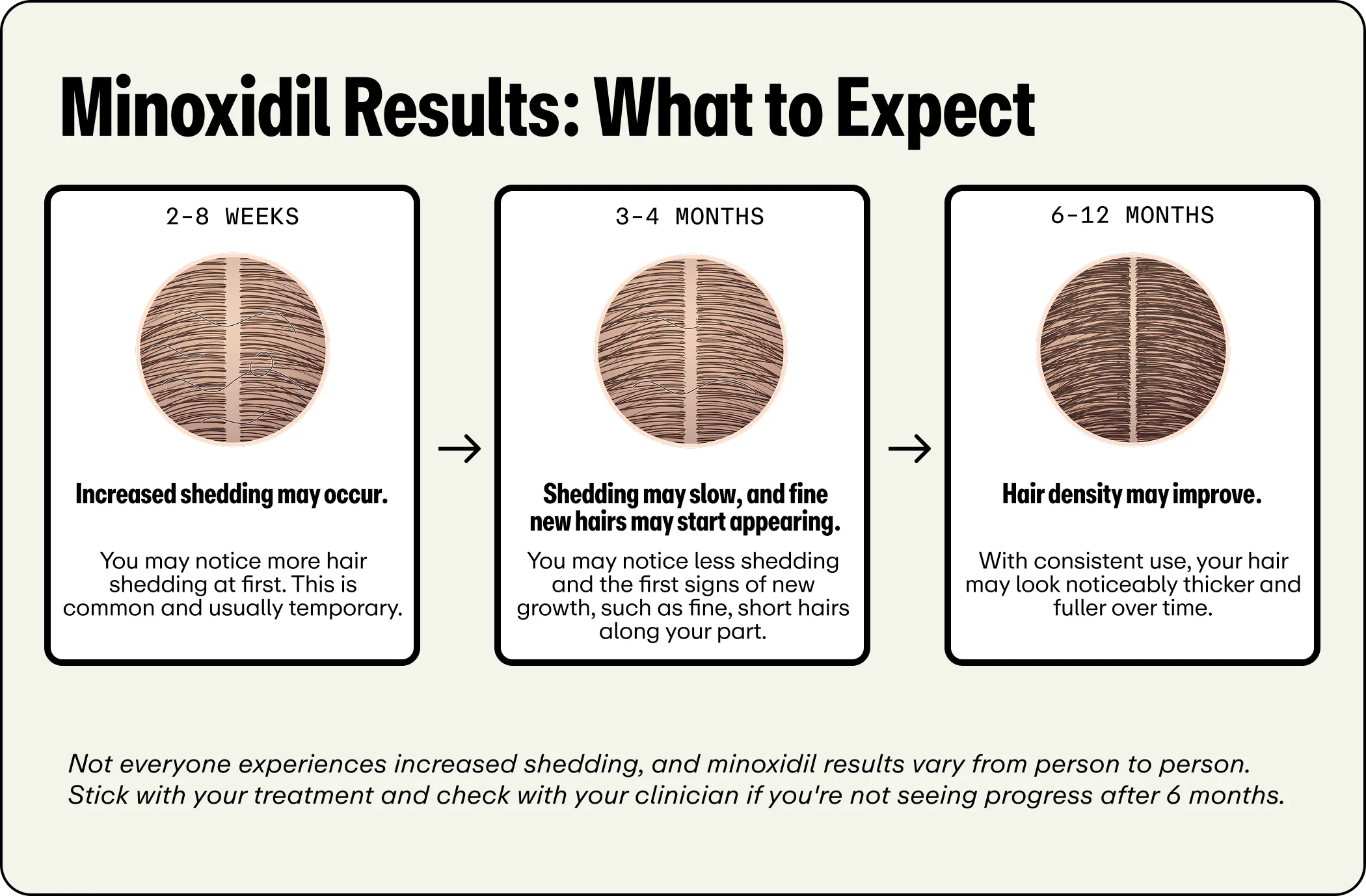 A three-step timeline infographic titled "Minoxidil Results: What to Expect". At 2 to 8 weeks, temporary increased hair shedding may occur. At 3 to 4 months, shedding slows and fine new hairs begin appearing along the part. By 6 to 12 months, hair density improves with noticeably thicker growth. A footer note explains that results vary and recommends consulting a clinician if no progress is seen after 6 months.
