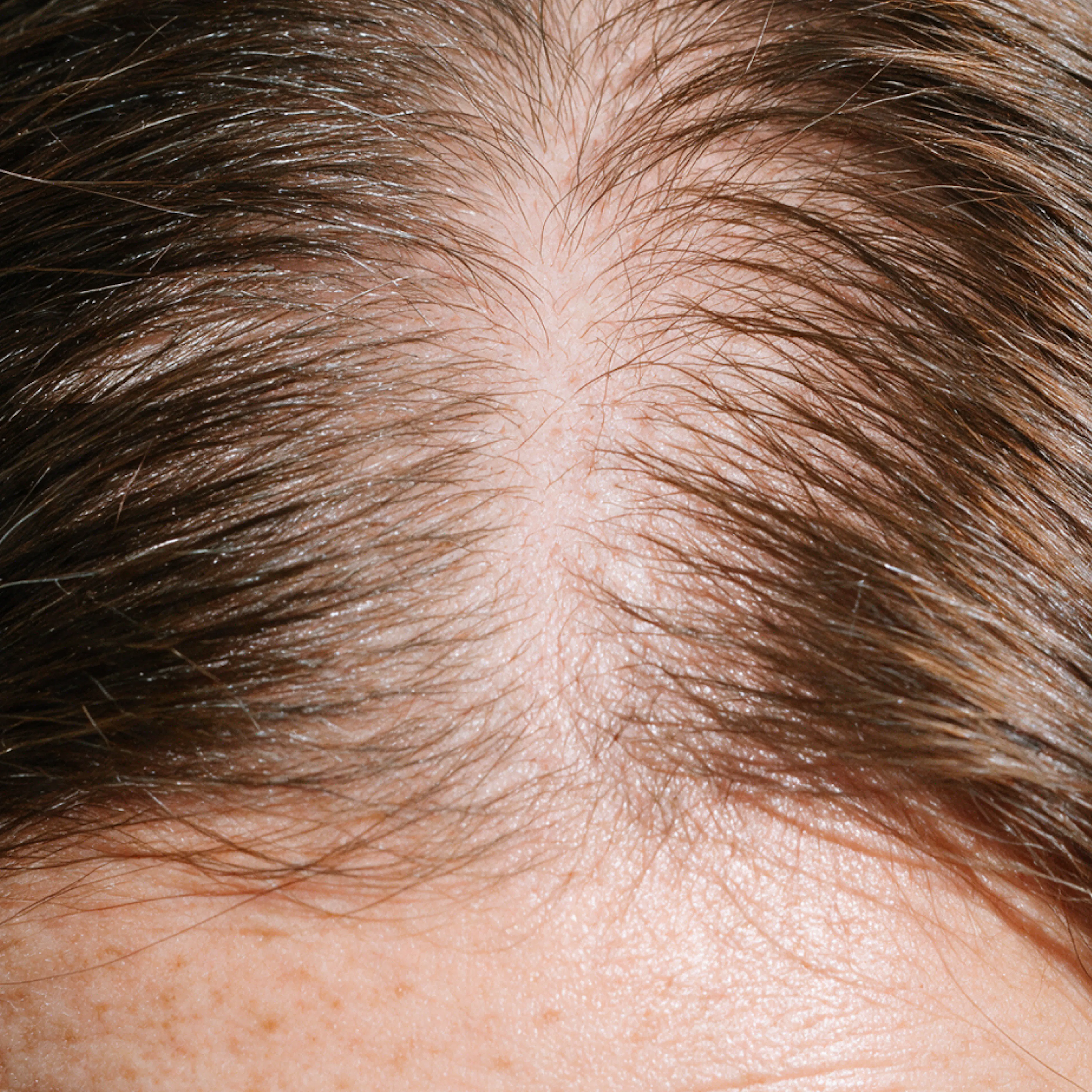 A close-up image of a woman's scalp. She has a wide part and is dealing with hair loss.