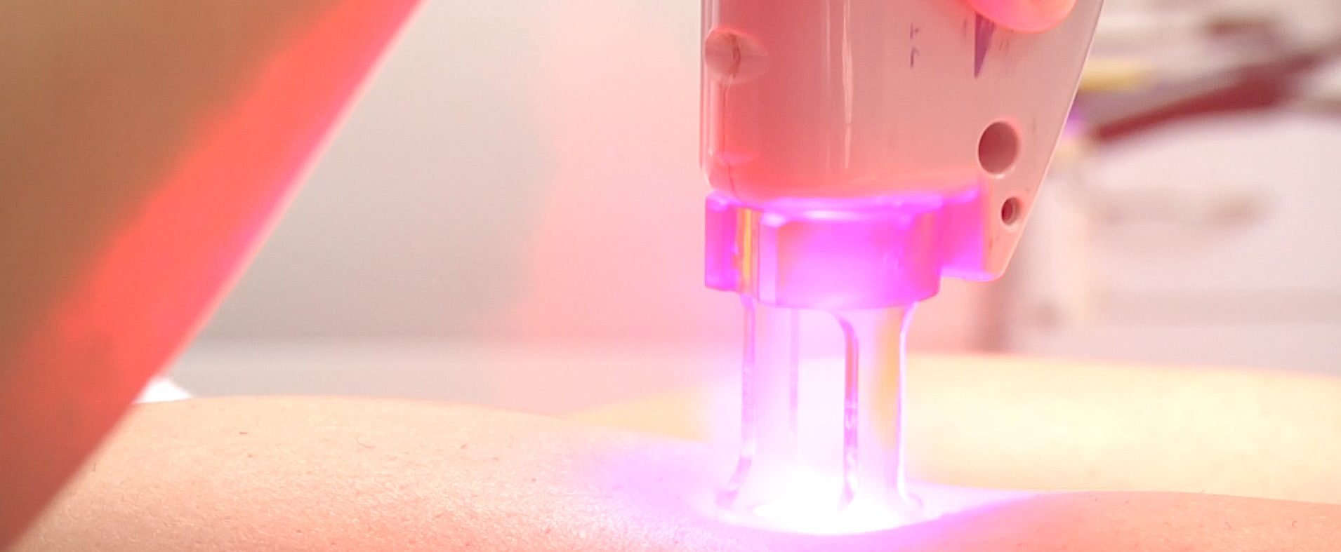 Laser treatment for dark spots on black skin