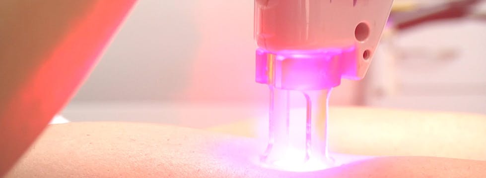 Laser treatment for dark spots on black skin Laser treatment for dark spots on black skin