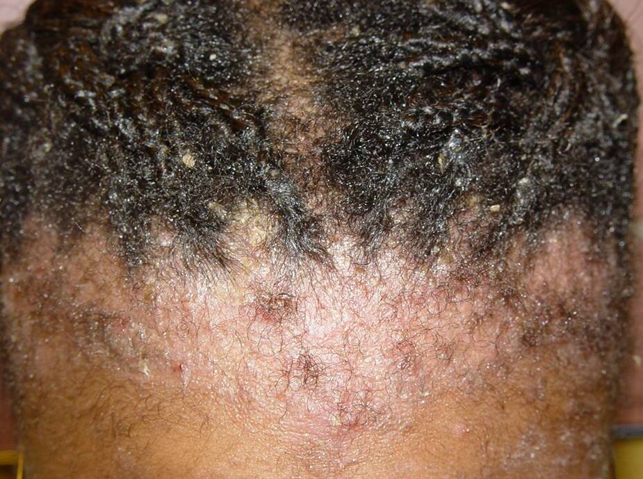 Itchy Scalp Causes  Treatment