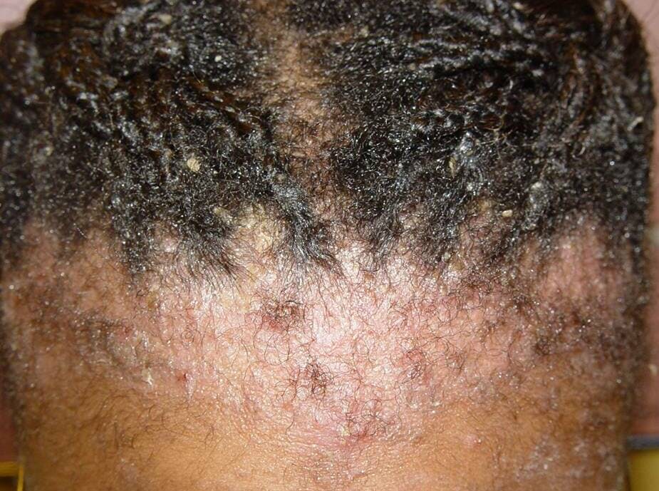 Dry Itchy Scalp Natural Hair Remedies Treatment 4c Black Hair