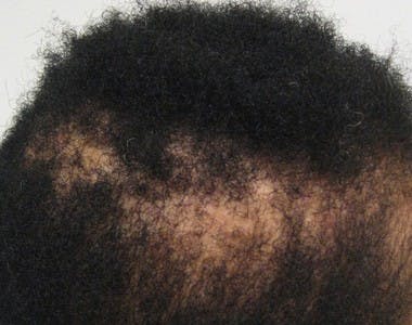 african hair loss treatment