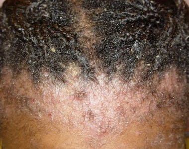 itchy scalp 4c natural hair