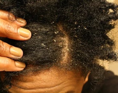 afro hair dandruff