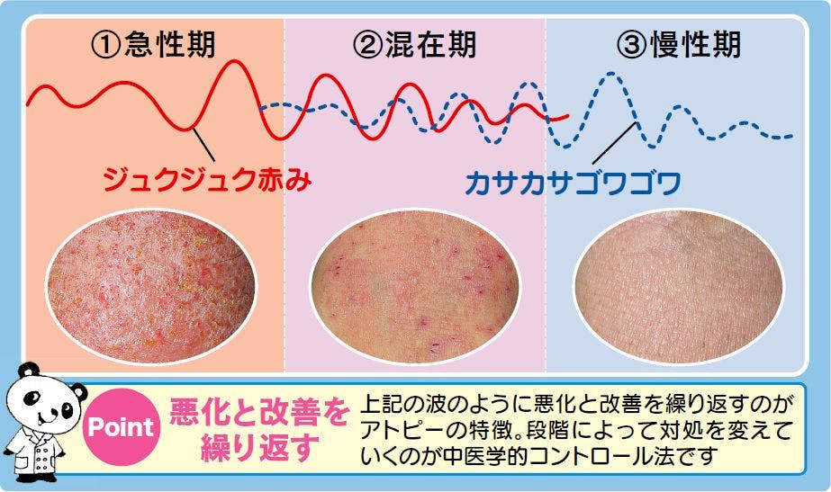 アトピー性皮膚炎でお悩みの方 漢方薬局 開気堂薬局 アトピー性皮膚炎でお悩みの方 漢方薬局 開気堂薬局