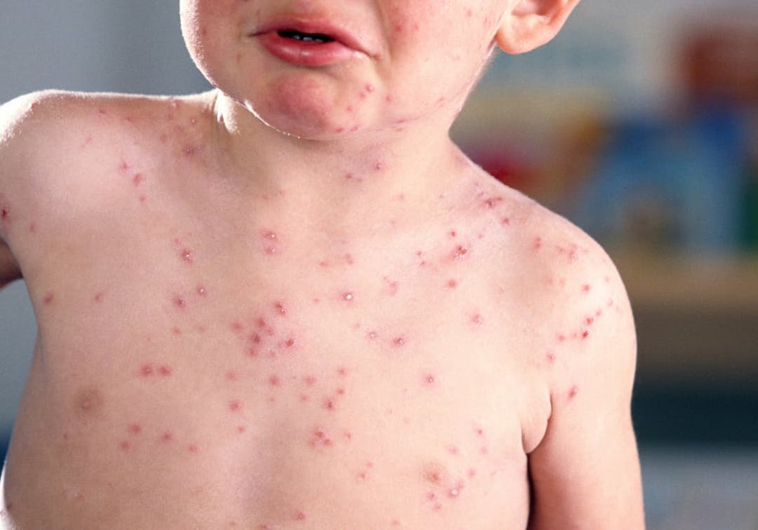 pojke med vattkoppor