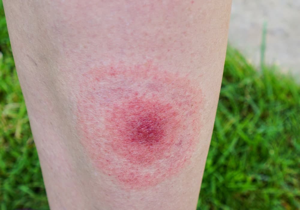 Borrelia visar sig genom en ringformad rodnad runt fästingbettet, ofta större än en 5-krona