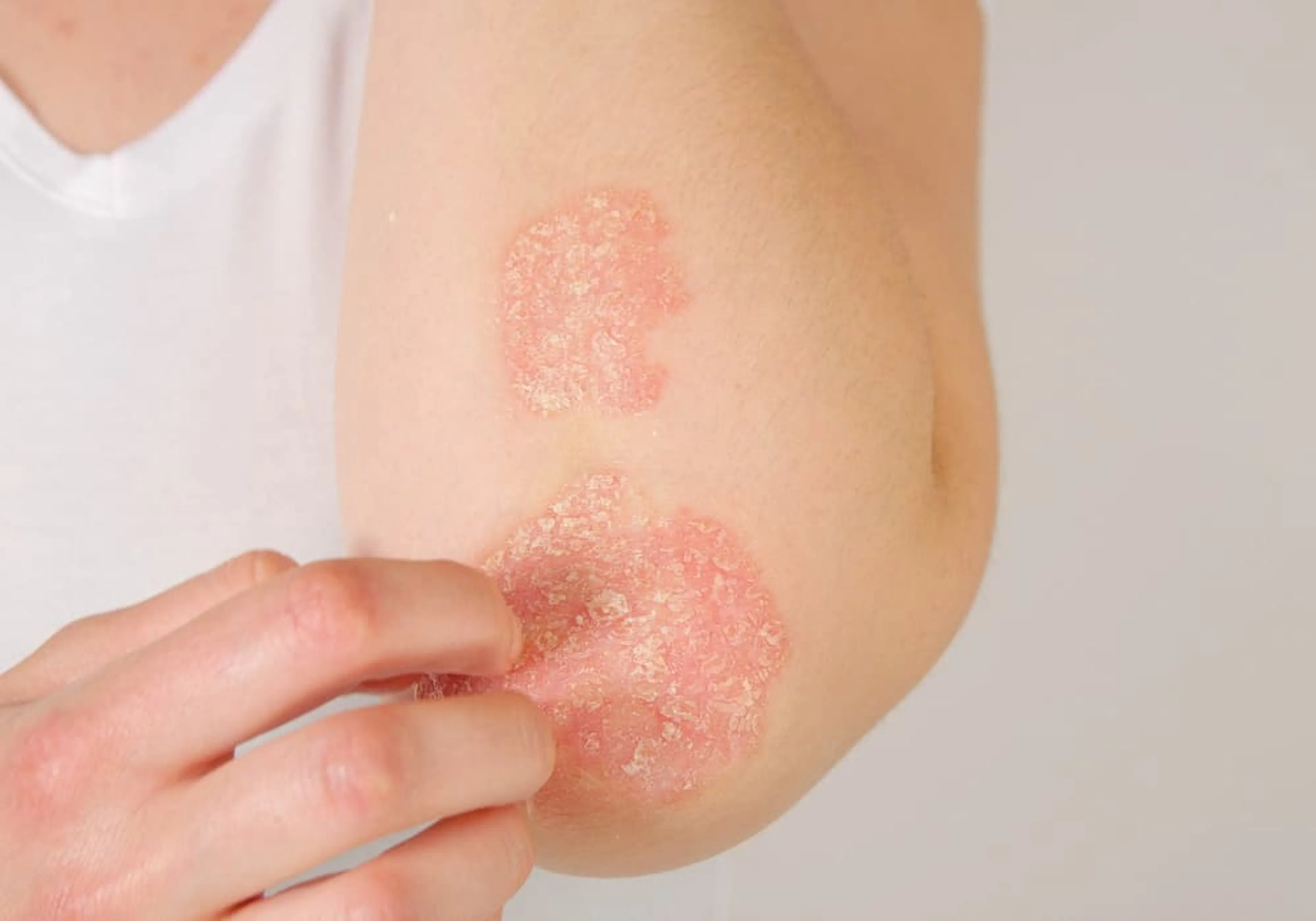 psoriasis på arm