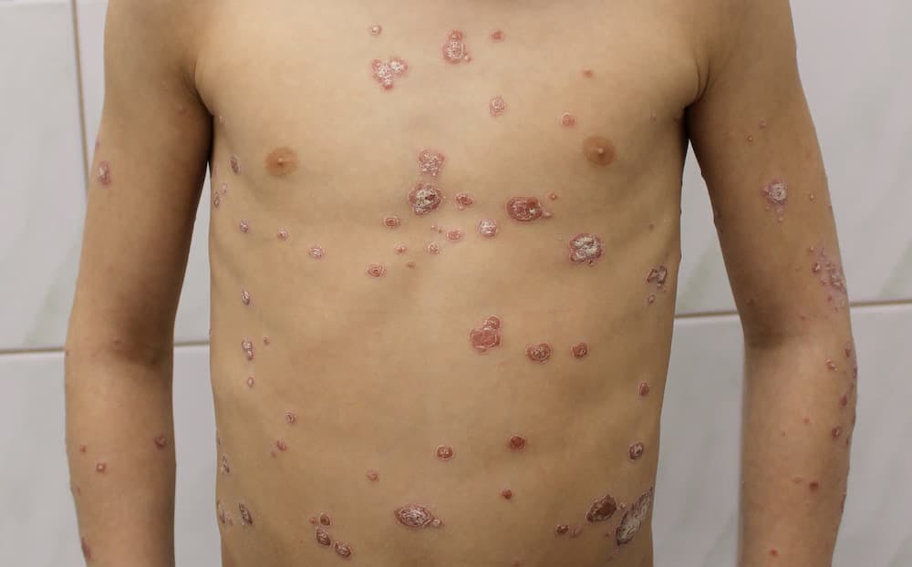 utslag orsakade av psoriasis