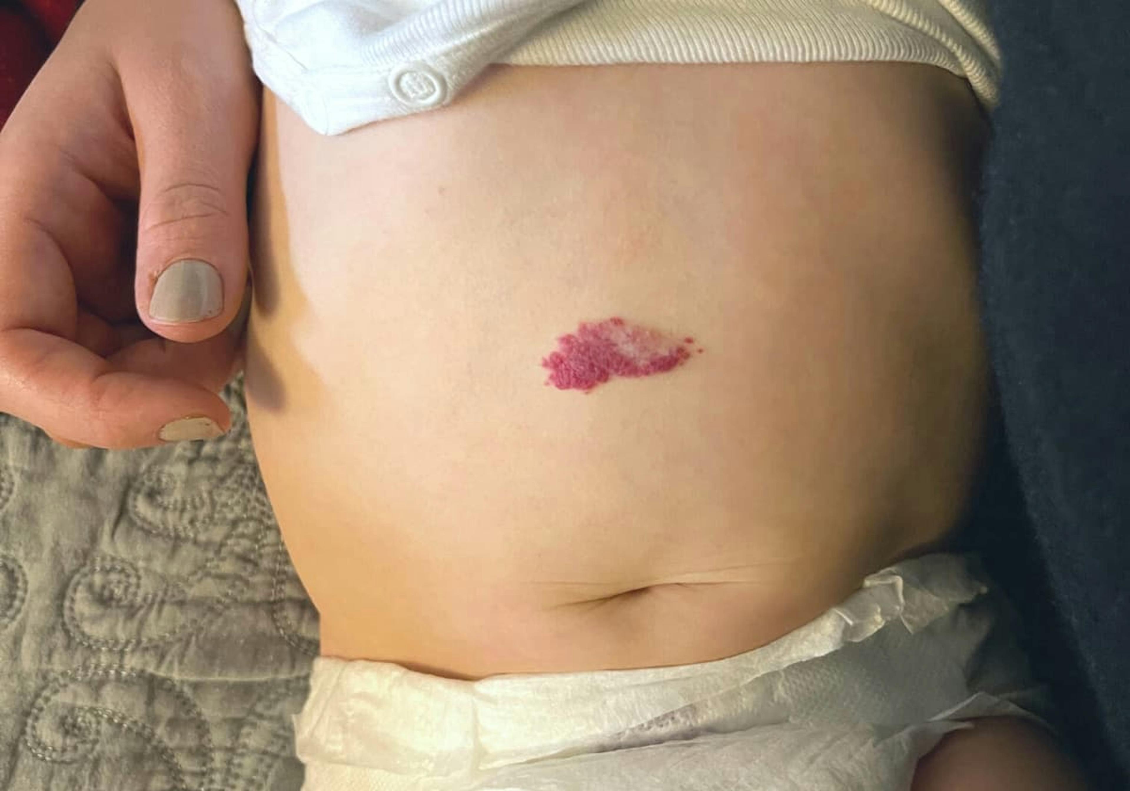 Smultronmärke på bebis mage